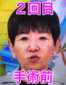 和田アキ子目が違う 和田アキ子の顔と目変わったのは整形でなく眼瞼下垂の失敗！再手術の画像比較！｜メモリア
